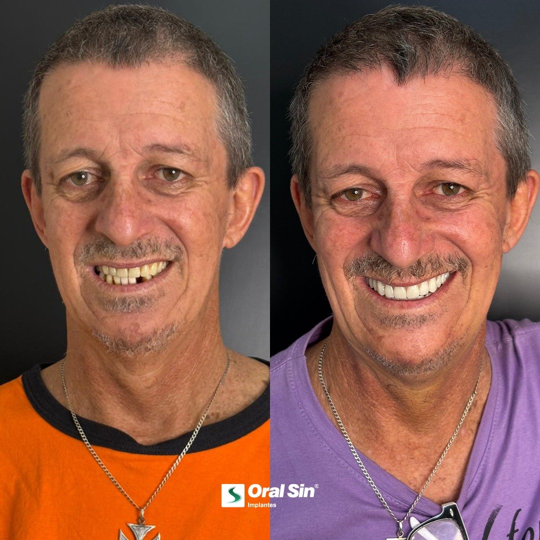 Caso 3 - Transformação de sorriso