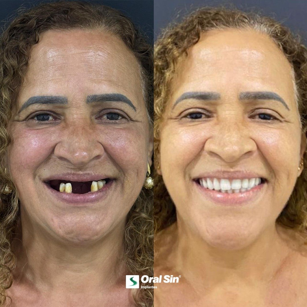Caso 4 - Transformação de sorriso